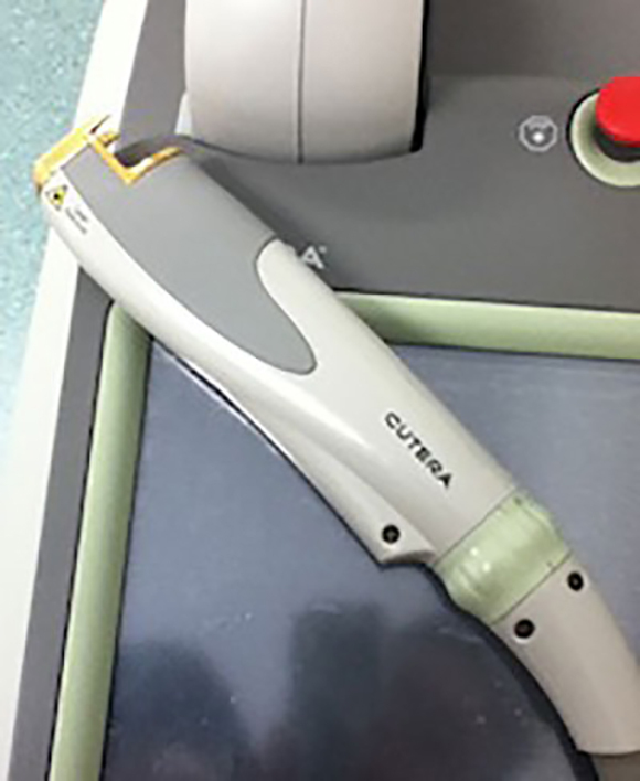 レーザージェネシス