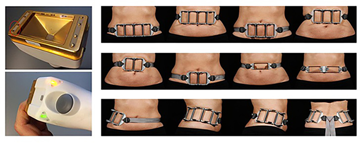 部分痩身によるボディメイクに効果的